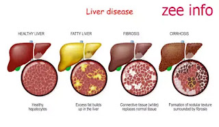 Liver cirrhosis |  cirrhosis of the liver