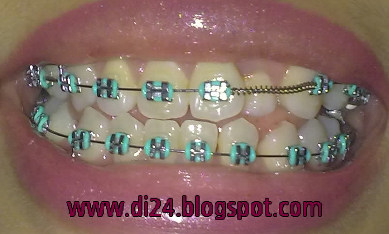 Gambar Tangerine Braces Part 4 Warna Gambar Kawat  Gigi  