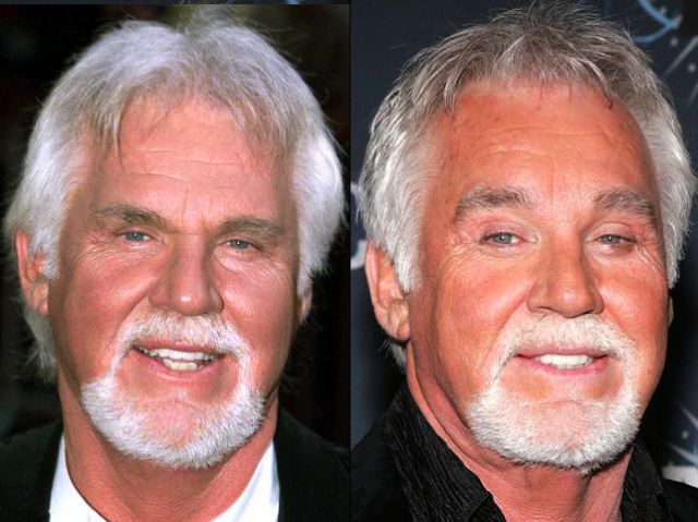 kenny rogers  plastic surgery