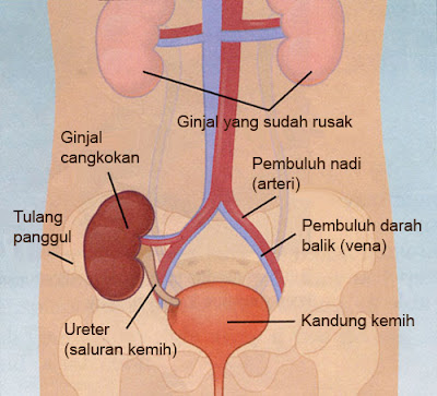 Penyebab Kristal di Saluran Kencing dan Gejalanya