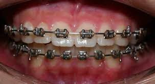 Braces Treatment in Gurgaon