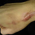 apa yang dimaksud dengan keloid