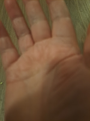 Photo of palm of healed hand. It has 3 horizontal lines instead of the usual 2.