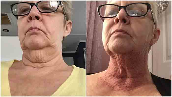 Woman left with ‘lizard neck’ after skin-tightening procedure goes wrong, London, News, Cheating, Social Media, World.