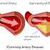 Home Remedies Coronary Artery Disease (Ischemic Heart Disease), Natural Treatment of Heart Disease