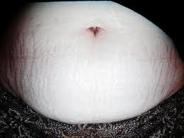 remove stretch marks from stomach