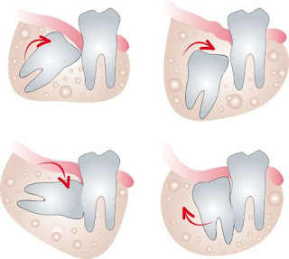 Răng khôn có phải răng số 8 không-2