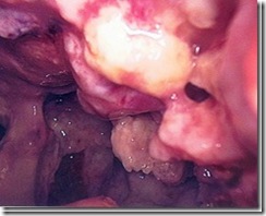 Mesothelioma-1_thumb[3]