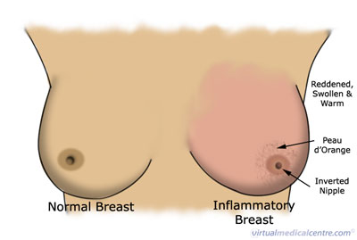 Breast Cancer