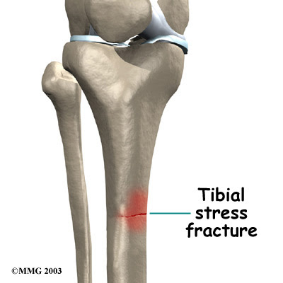 STRESS FRACTURE TIBIA X RAY