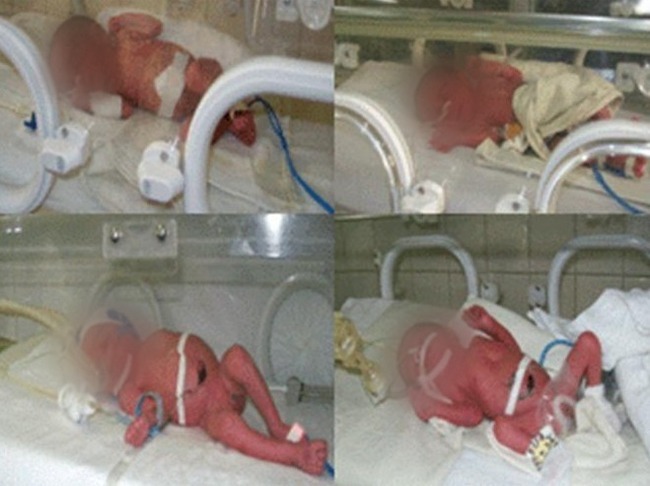 Estados/ Nacen cuatrillizos, tres niñas y  un niño, en hospital de Morelos