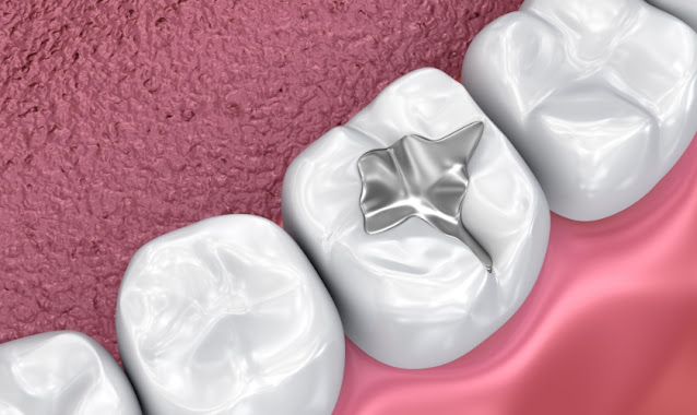 Dental Sealants, Dentist Charlotte, Charlotte Dentist