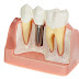Trồng răng sứ nguyên hàm bằng implant