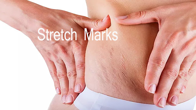 stretch marks how to remove from breast - thigh - buttock - lower belly women - men Naturally
