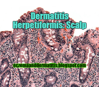 Dermatitis Herpetiformis: Scalp