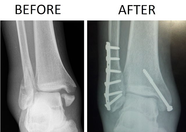 ankle fracture causes symptoms treatment