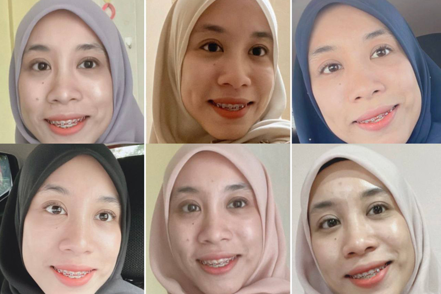 sakit ke pakai braces, best ke tak pakai braces, tips pakai braces,