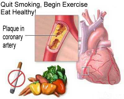 Often 1st sign is a HEART ATTACK; More than 2/3 of a coronary artery may be 