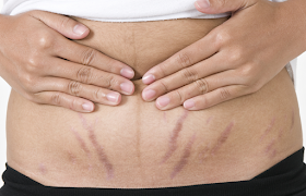 How to Get Rid of Stretch Marks Naturally