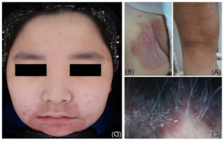 Rash study treatments, diagnosis and symptoms in children and adolescents