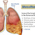 Mesothelioma Cancer: Symptoms of Mesothelioma Cancer - BlogNews-24