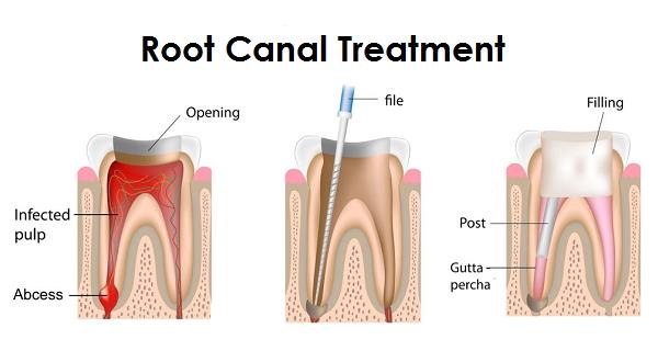 Root Canal Treatment in India – Facts You Need To Know