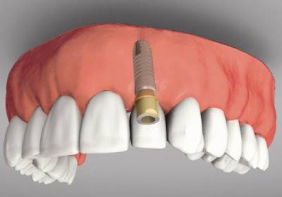Chi phí cấy ghép răng implant tại nha khoa Đăng Lưu