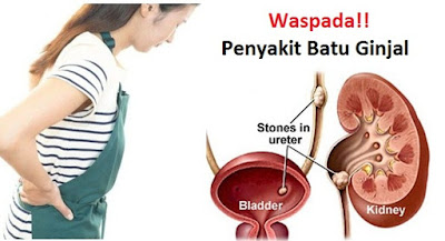 Obat Batu Ginjal/Kencing Batu Paling Ampuh Manjur Dan Mujarab