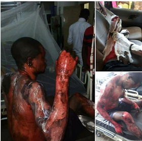 Jealous Wife Bathes Husband With Hot Water For Marrying Another Woman.