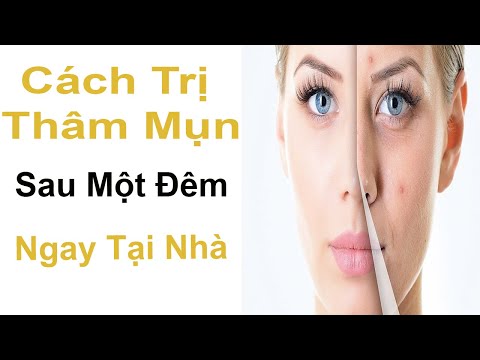 Cách trị mụn thâm tại nhà