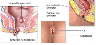 penyakit ambeien bisa sembuh, kempeskan benjolan wasir, efek penyakit ambeien atau wasir, mengobati ambeien atau wasir dengan daun jambu biji, obat herbal wasir atau ambeien eksternal, obat penyakit ambeyen minum, pengobatan wasir atau ambeien dari luar, obat ampuh mengatasi penyakit ambeien, mengobati gejala wasir, atasi ambeien atau wasir tanpa operasi, obat ambeien yang paling manjur, cara mengobati penyakit wasir tanpa minum obat, penyakit wasir atau ambeien bisa sembuh, cara mengobati wasir yang luka, cara mengatasi wasir atau ambeien dengan buah, mengatasi ambeien atau wasir secara herbal, cara mengobati penyakit wasir yang sudah berdarah, www.obat ambeien atau wasir ampuh.com, penyebab bengkak wasir, sakit ambeien atau wasir obatnya apa, cari obat ambeien atau wasir/ambeien, cara mengobati penyakit ambeien kronis, cara mengobati ambeien atau wasir dengan cara herbal, obat untuk mengobati wasir wanita hamil, olahraga mengobati penyakit ambeyen, mengobati ambeien atau wasir dengan buah, cara mengobati ambeien atau wasir internal, cara mengobati wasir atau ambeien yang keluar, apa obat ambeien berdarah, obat untuk penyakit ambeien aman untuk ibu menyusui