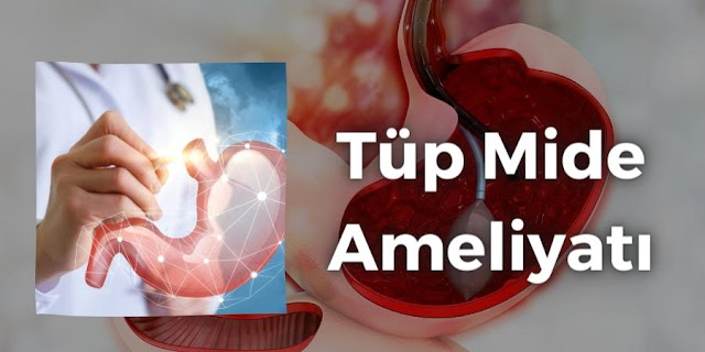 Tüp Mide Ameliyatı