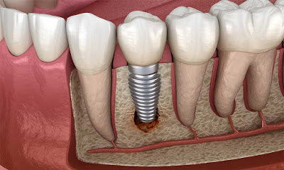 implant