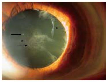 Homocysteine related eye problem