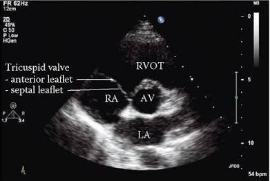 PSAX view showing Anterior and septal leaflet of Tricuspid Valve