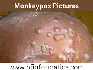 Monkeypox pictures and symptoms