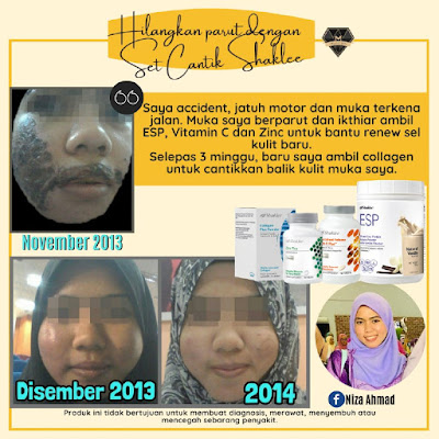 Hilangkan Parut Di Muka Dengan Set Cantik Shaklee