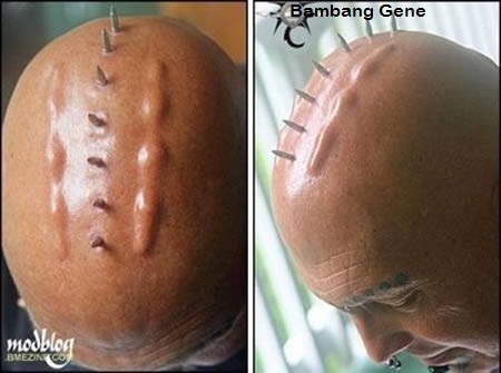 12 Benjolan Tubuh Paling Aneh|bambang-gene.blogspot.com