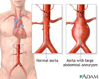 Abdominal Aortic Aneurysm