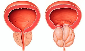 image avec prostate gonflée: traitements naturels et exercices efficaces