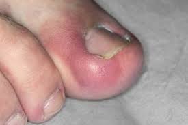 The Causes of Ingrown Toenails