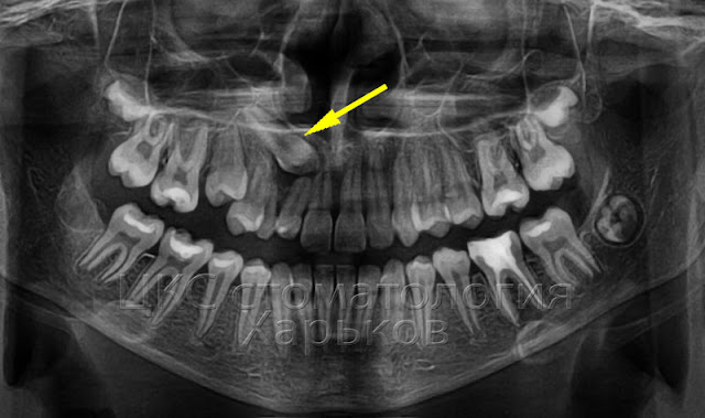 Панорама пациента с атипично расположенным клыком верхней челюсти
