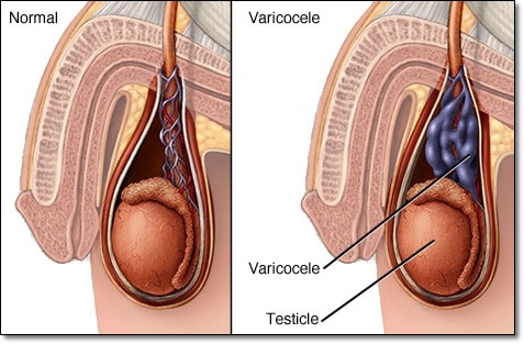 Biaya Operasi Varikokel Saat Ini