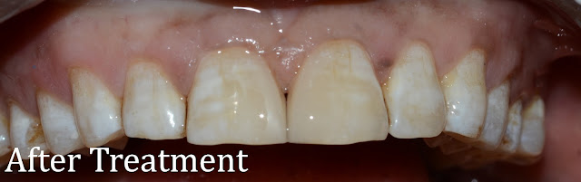 After Treatment for Spacing Between Teeth