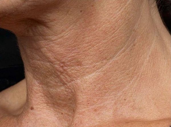 Aplica este remedio casero para eliminar las arrugas del cuello