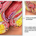 Obat Wasir atau Ambeien Herbal thumbnail