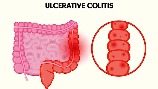 https://www.healthandfitnessexpert.in/2024/03/ulcerative-colitis-symptoms-and-causes.html