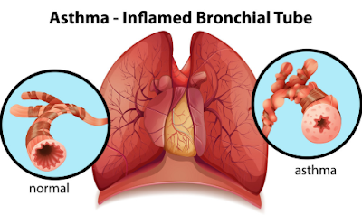 Stop Asthma By Using Just A Little Of This Juice