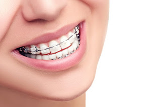 Cách làm cho răng đều tại nha khoa-2