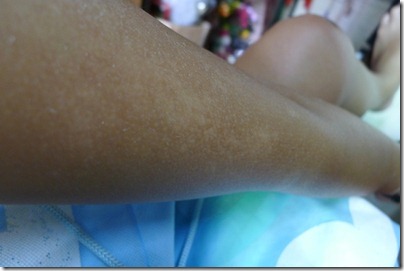 sunburn spot